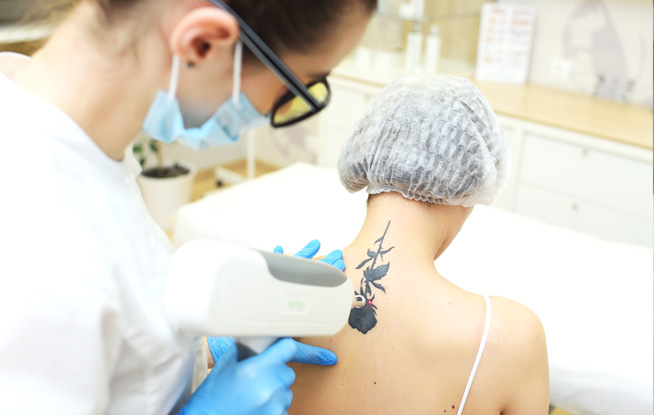 Tratamiento eliminar tatuajes en Alcalá de Henares